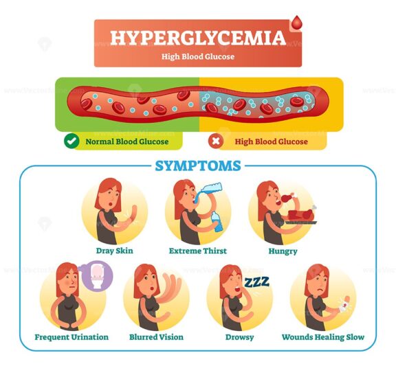 Hyperglycemia vector illustration collection set
