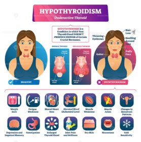 Hypothyroidism vector illustration