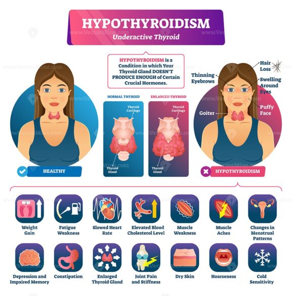 Hypothyroidism vector illustration
