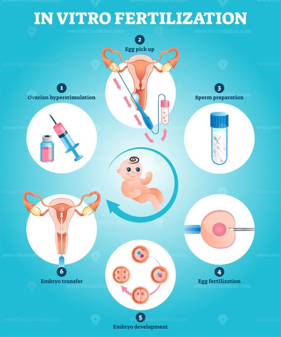 In Vitro fertilization artificial pregnancy reproduction vector illustration