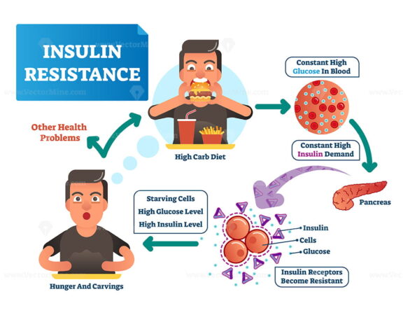 Insulin resistance vector illustration