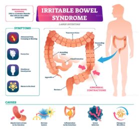 Irritable bowel syndrome vector illustration