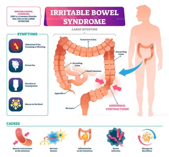 Irritable bowel syndrome vector illustration