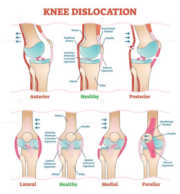 Knee dislocations - medical vector illustration diagrams