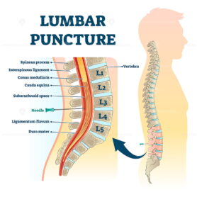 Lumbar puncture vector illustration