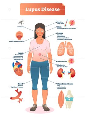 Lupus disease vector illustration
