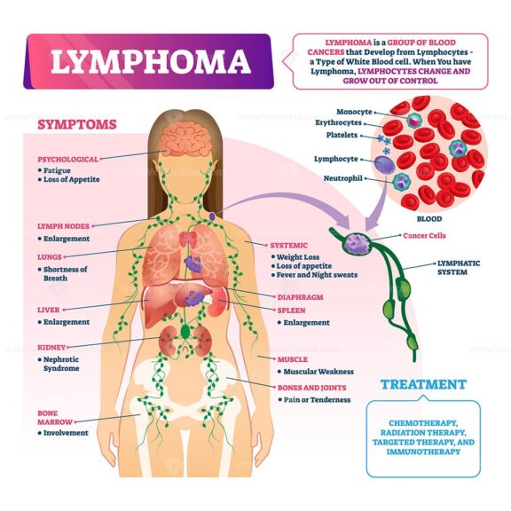 Lymphoma vector illustration