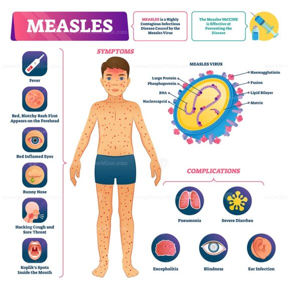 Measles vector illustration