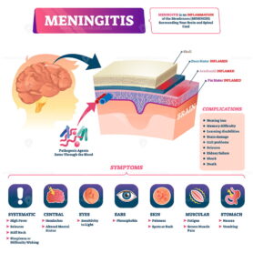 Meningitis vector illustration