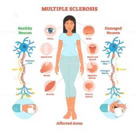 Multiple sclerosis anatomical vector illustration diagram, medical scheme with affected area icons and damaged neuron bio anatomy