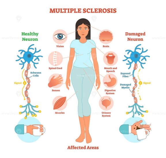 Multiple sclerosis anatomical vector illustration diagram, medical scheme with affected area icons and damaged neuron bio anatomy