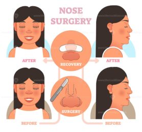 FREE Nose plastic surgery vector illustration