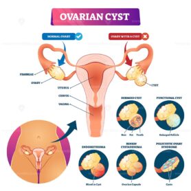 Ovarian cyst vector illustration