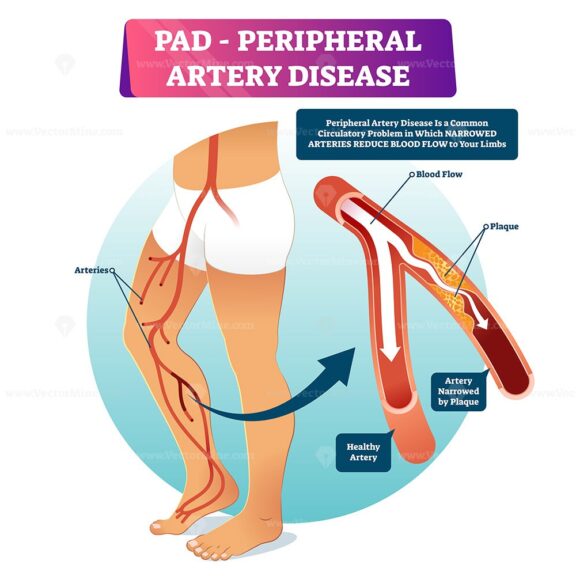 Peripheral artery disease PAD vector illustration