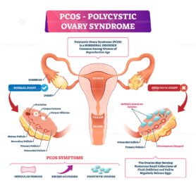 Polycystic ovary syndrome vector illustration
