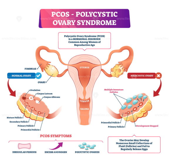 Polycystic ovary syndrome vector illustration