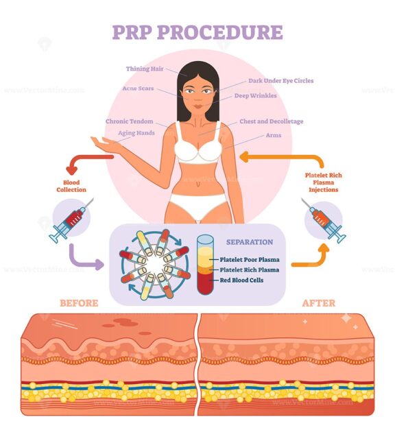 PRP Procedure vector illustration graphic diagram