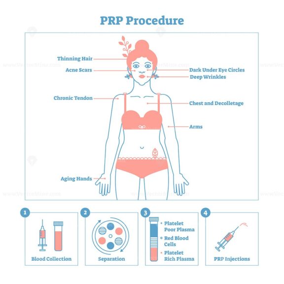 PRP Procedure vector illustration graphic diagram, cosmetology procedure scheme