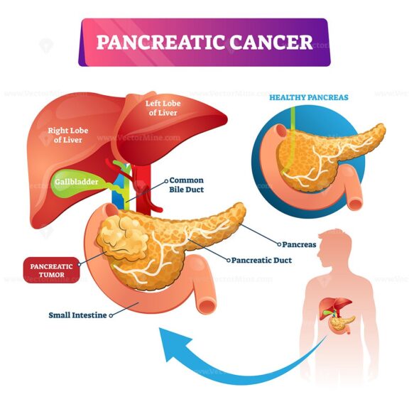 Pancreatic cancer vector illustration