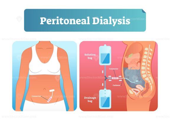 Peritoneal dialysis vector illustration