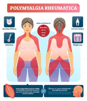 Polymyalgia rheumatica vector illustration