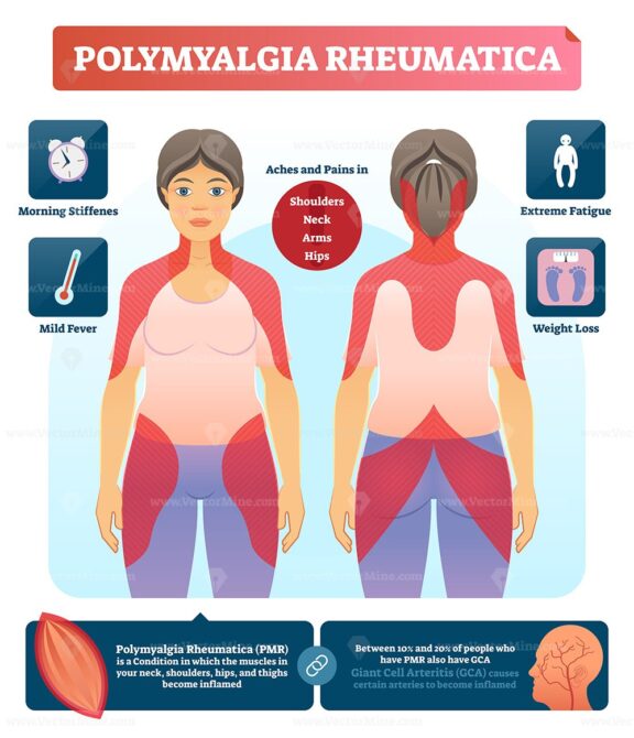 Polymyalgia rheumatica vector illustration