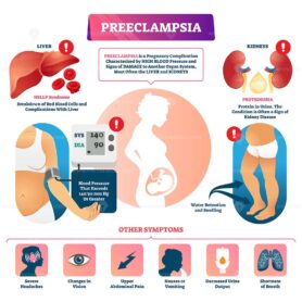 Preeclampsia vector illustration