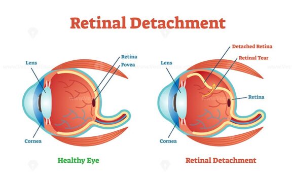 Retinal Detachment vector illustration diagram