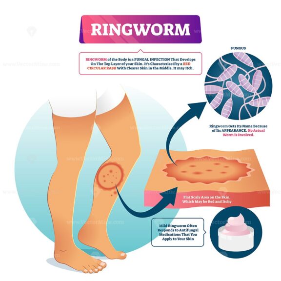 Ringworm vector illustration