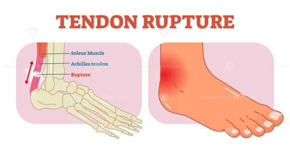 Tendon rupture anatomical example illustration