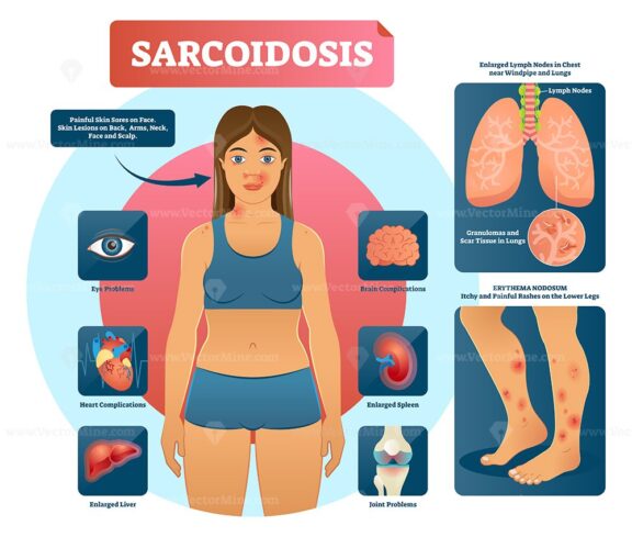 Sarcoidosis vector illustration