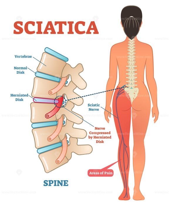 Sciatica medical health care vector illustration diagram scheme with lower spine and sciatic nerve pain in leg