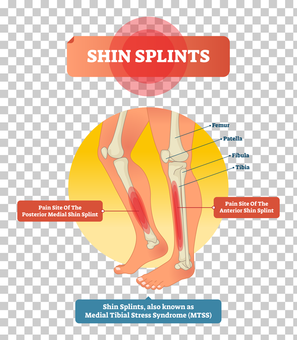 Shin splints vector illustration - Image 2