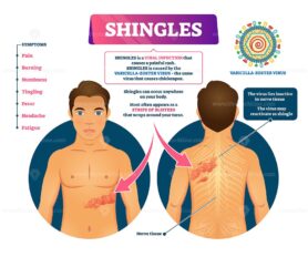 Shingles vector illustration