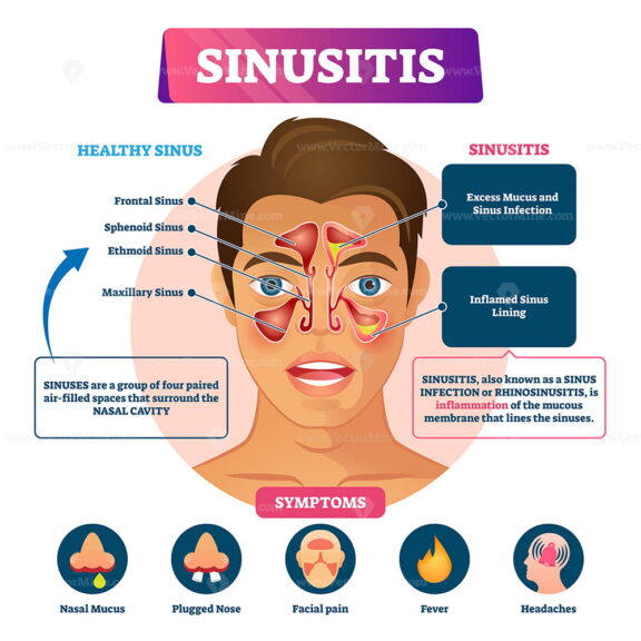 Sinusitis vector illustration
