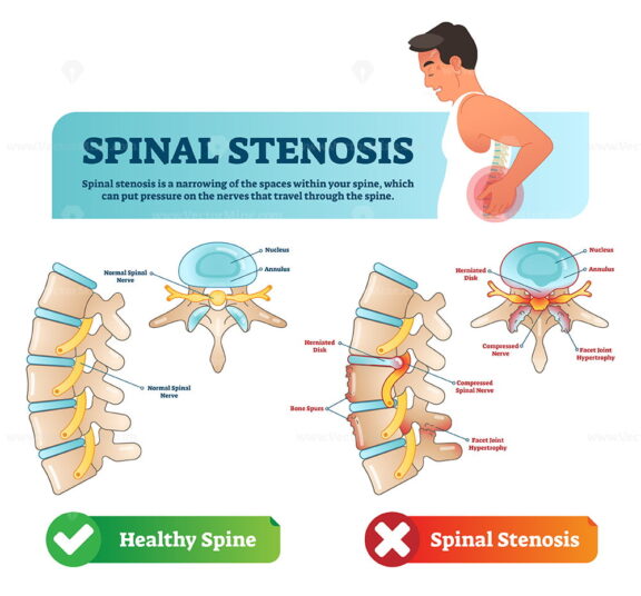 Spinal stenosis vector illustration
