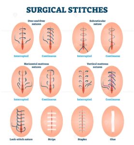 Surgical stitches vector illustration