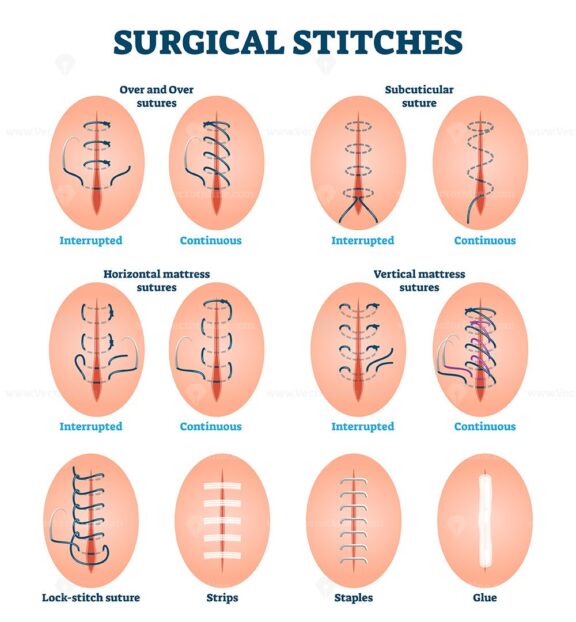 Surgical stitches vector illustration