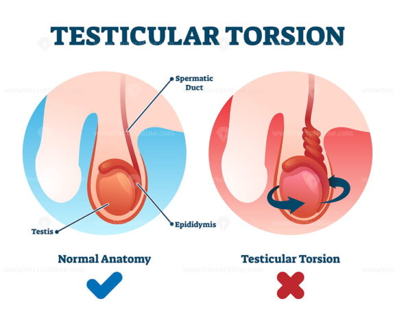Testicular torsion vector illustration