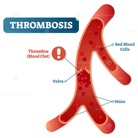 Thrombosis medical vector illustration cross section diagram,unhealthy blood vessel circulatory system disease