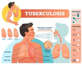 Tuberculosis vector illustration