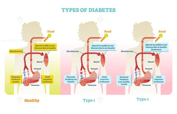 Types of diabetes vector illustration diagram