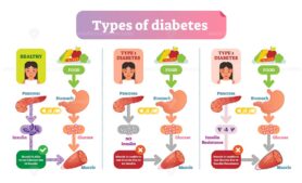 Types of Diabetes simple medical vector illustration scheme