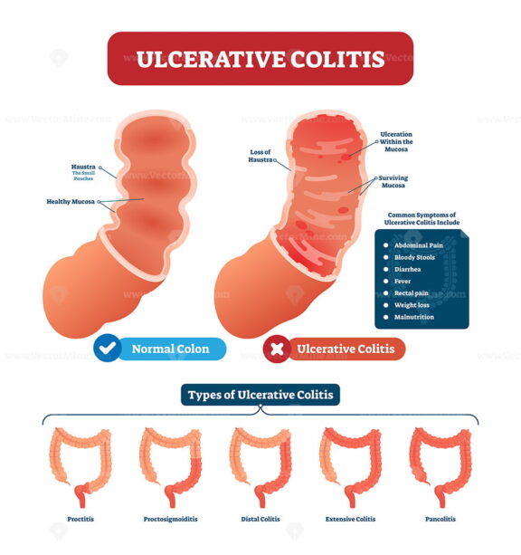Ulcerative colitis vector illustration