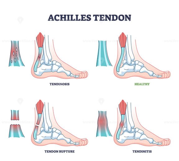 Achilles tendon injury types as leg or ankle trauma examples outline diagram
