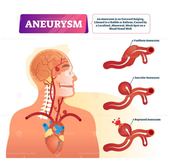 Aneurysm vector illustration