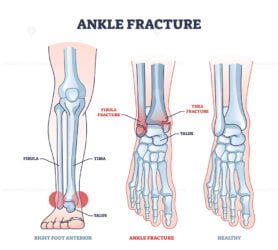 Ankle fracture and right foot anterior trauma medical view outline diagram