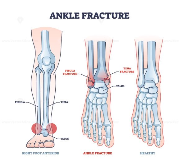 Ankle fracture and right foot anterior trauma medical view outline diagram
