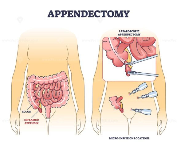 Appendectomy diagram shows the inflamed appendix, colon, and laparoscopic surgery tools in a clear medical outline. Outline diagram