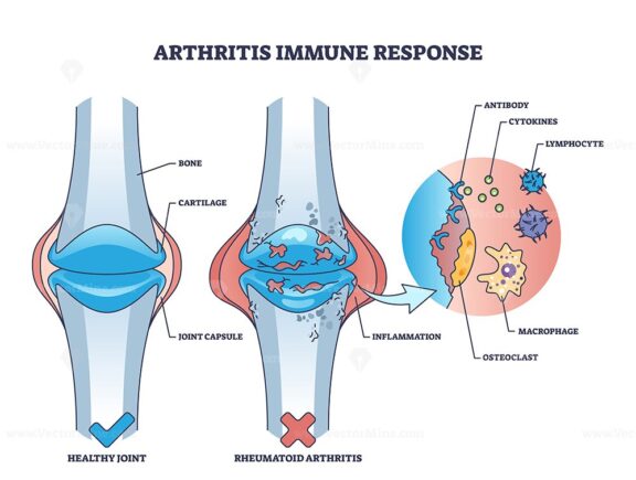 Arthritis immune response with rheumatoid bone disease outline diagram